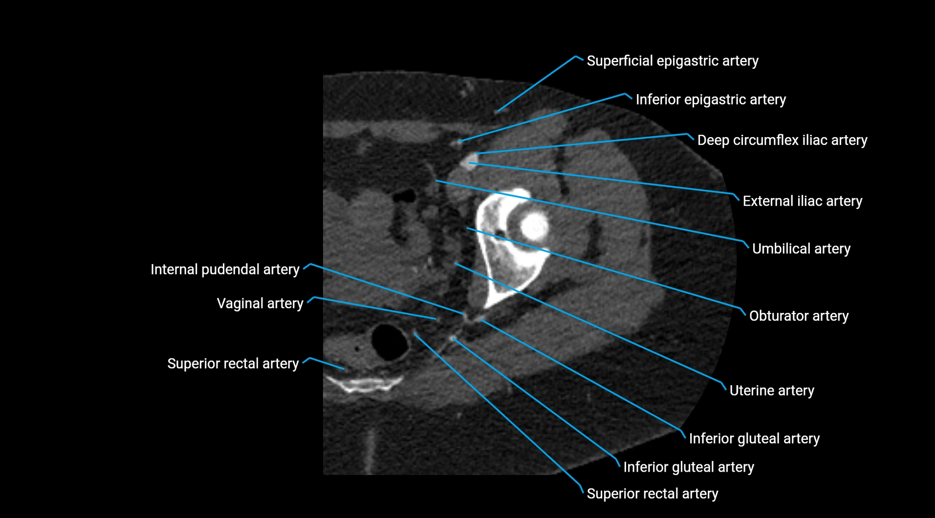 CTA lower limb cross sectional anatomy labelled image _49.webp
